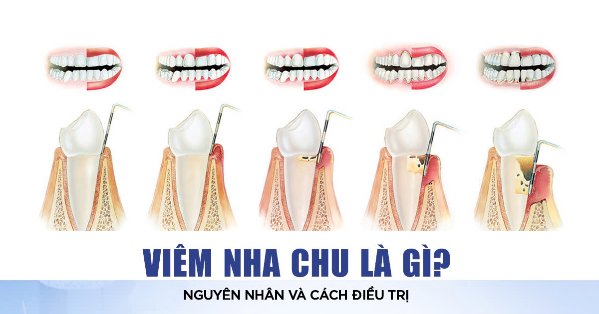 viêm nha chu - nguyên nhân và cách điều trị