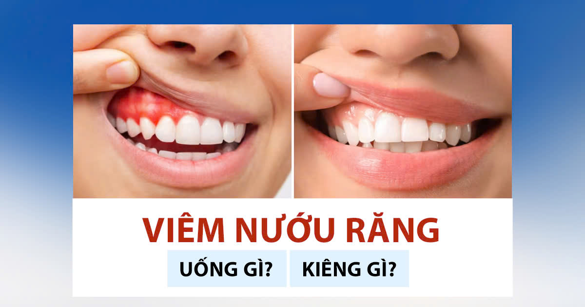 Viêm Nướu Răng Uống Gì và Kiêng Gì? 1