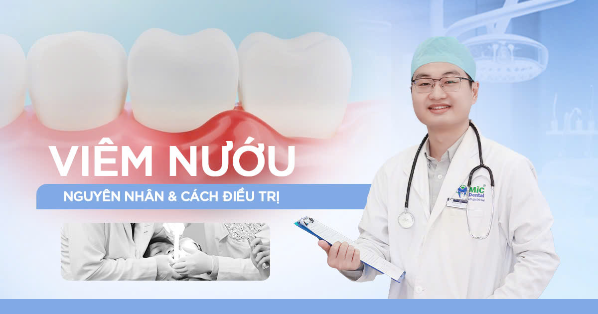 viêm nướu - nguyên nhân và cách điều trị hiệu quả