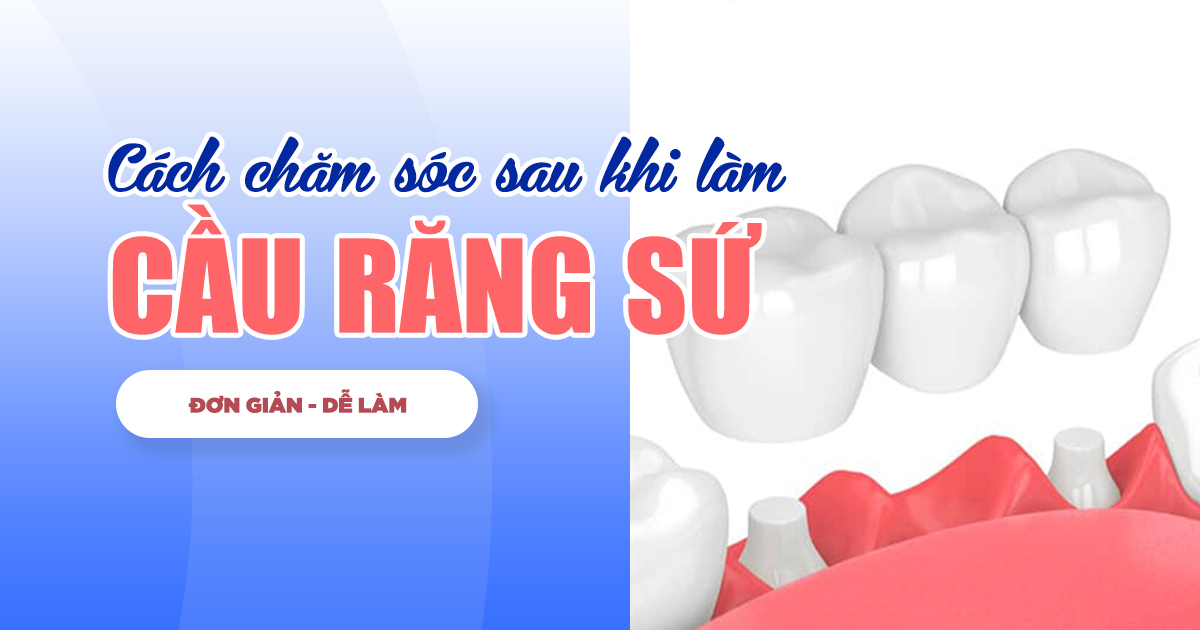 Cách Chăm Sóc Sau Khi Làm Cầu Răng Sứ: Đơn Giản, Dễ Dàng 1