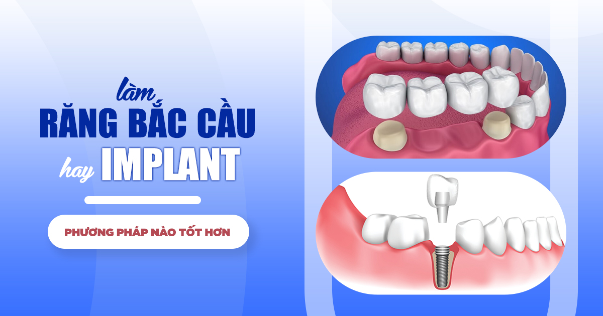 Làm Răng Bắc Cầu Hay Implant? Phương Pháp Nào Tốt Hơn 3
