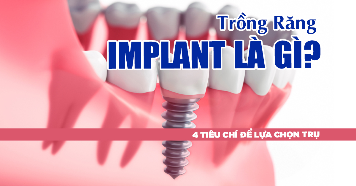 Trồng Răng Implant Là Gì? 4 Tiêu Chí Để Lựa Chọn Trụ 1