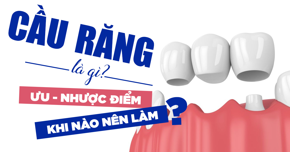 Cầu Răng Là Gì? Ưu, Nhược Điểm, Khi Nào Nên Làm? 4