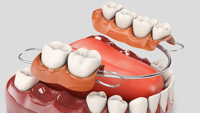 Răng Giả Tháo Lắp 2 Chiếc Có An Toàn Không? Giá Bao Nhiêu? 4