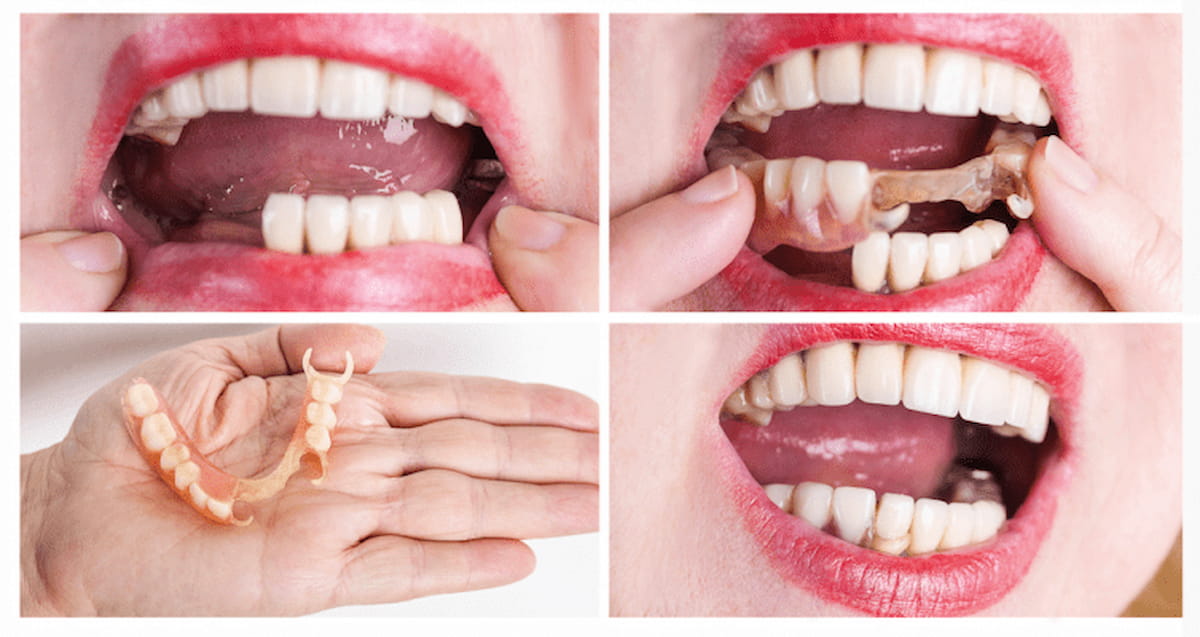 Răng Giả Tháo Lắp 1 Cái Có Được Không? Quy Trình & Giá Cả 4