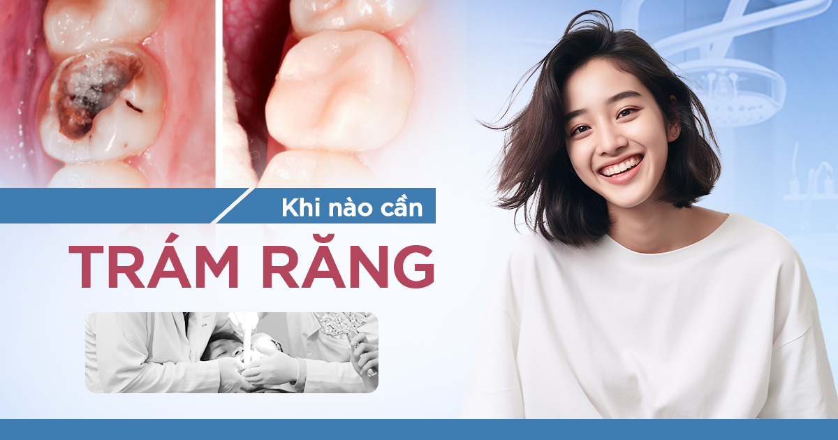 Khi Nào Cần Trám Răng? Trường Hợp Nào Nên Chờ 4