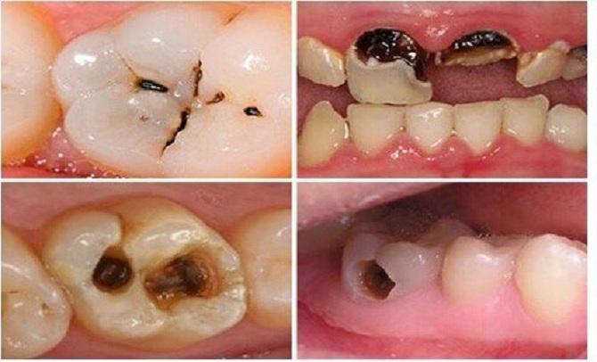 Khi Nào Cần Trám Răng? Trường Hợp Nào Nên Chờ 3