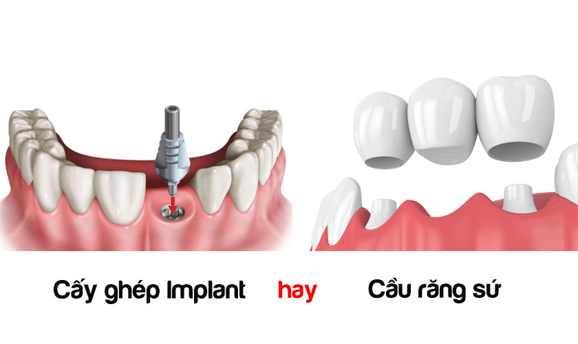 Làm Răng Bắc Cầu Hay Implant? Phương Pháp Nào Tốt Hơn 2
