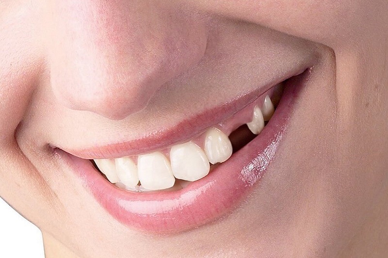Răng Giả Tháo Lắp 1 Cái Có Được Không? Quy Trình & Giá Cả 2