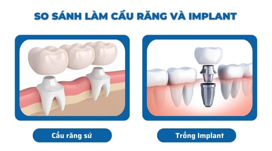 Làm Răng Bắc Cầu Hay Implant? Phương Pháp Nào Tốt Hơn 1