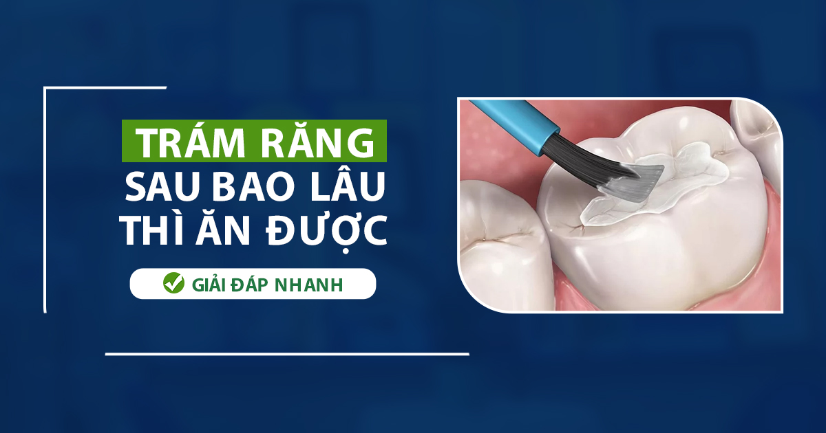 Trám Răng Sau Bao Lâu Thì Ăn Được? Giải Đáp Nhanh 5