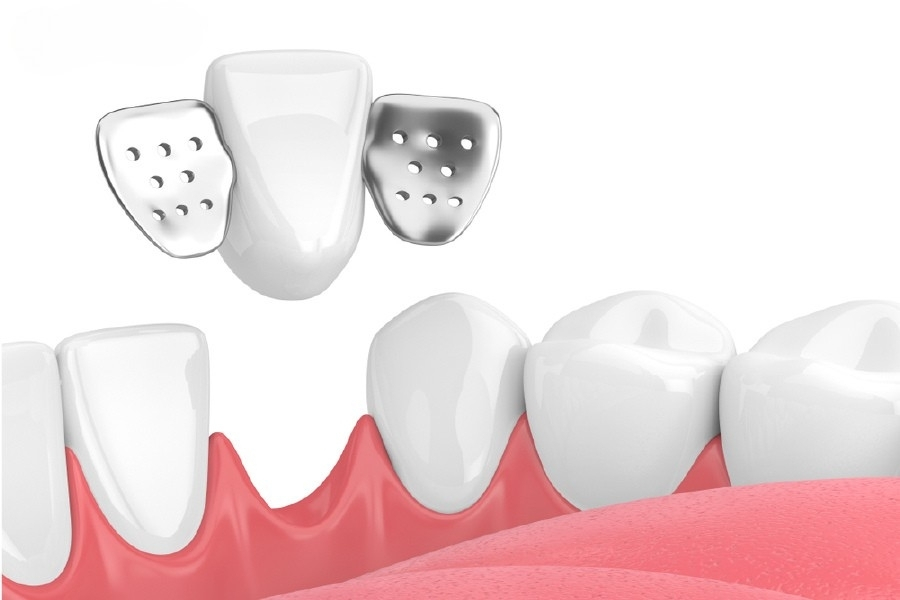 Cầu Răng Cánh Dán Là Gì? Phù Hợp Với Ai 1