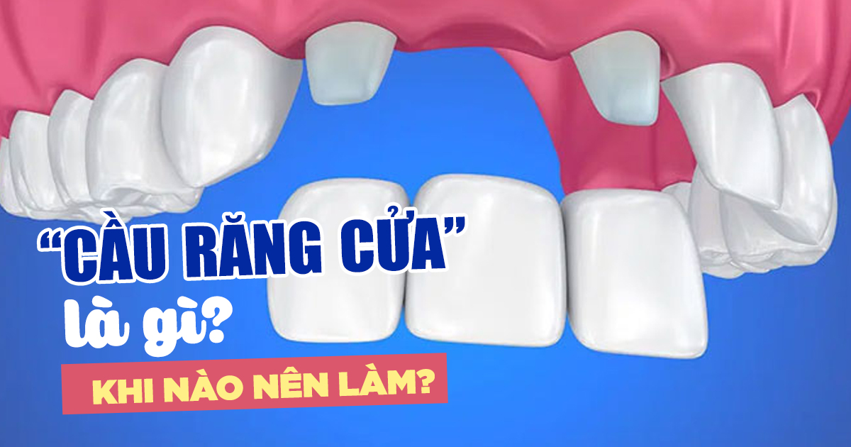 Cầu Răng Cửa Là Gì? Khi Nào Nên Làm 2