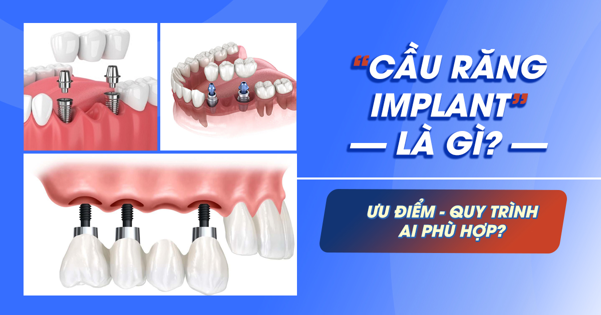 Cầu Răng Trên Implant Là Gì? Ưu Điểm, Quy Trình & Ai Phù Hợp 1