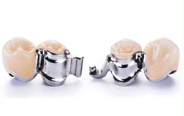 Cầu Răng Ngắt Lực Là Gì? Ưu Nhược Điểm & Khi Nào Nên Làm 1