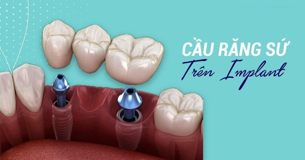 Cầu Răng Trên Implant Là Gì? Ưu Điểm, Quy Trình & Ai Phù Hợp 2