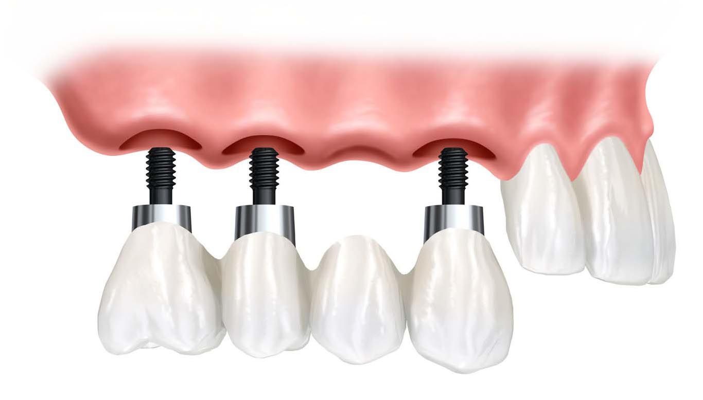 Cầu Răng Trên Implant Là Gì? Ưu Điểm, Quy Trình & Ai Phù Hợp 1