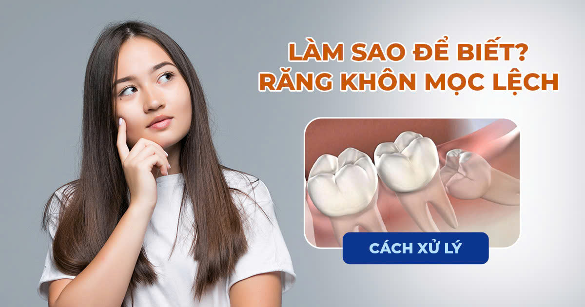 Làm Sao Để Biết Răng Khôn Mọc Lệch? Cách Xử Lý 4