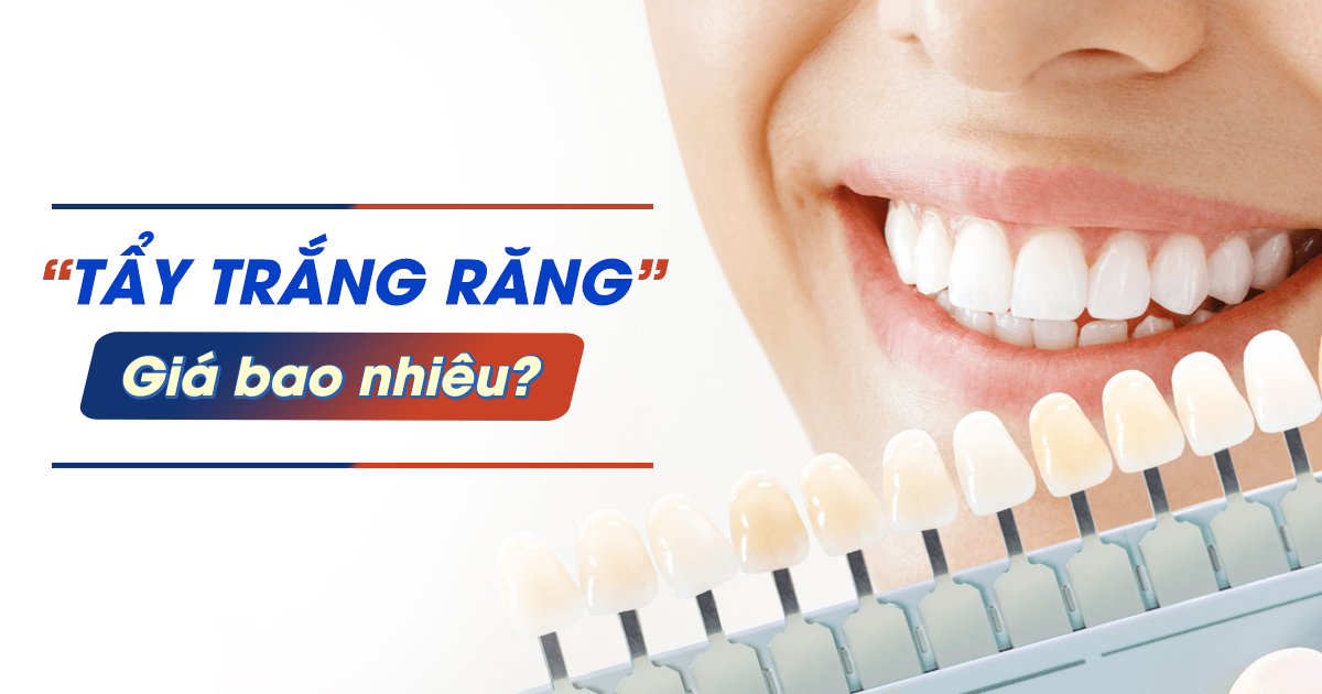 Tẩy Trắng Răng Giá Bao Nhiêu? Bảng Giá Mới Nhất 2025 1
