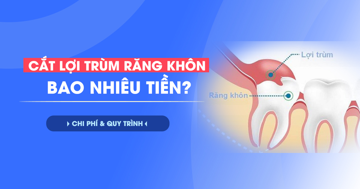 Cắt Lợi Trùm Răng Khôn Bao Nhiêu Tiền? Chi Phí & Quy Trình 2