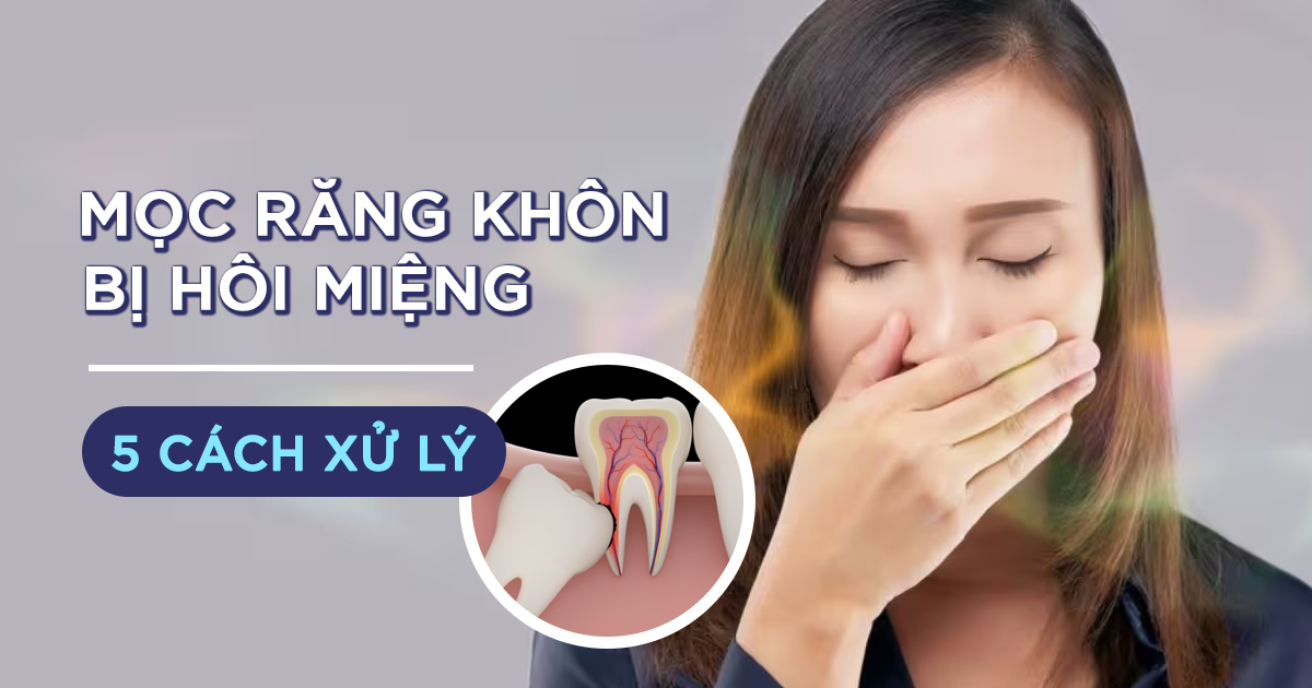 Mọc Răng Khôn Bị Hôi Miệng: 5 Cách Xử Lý 6