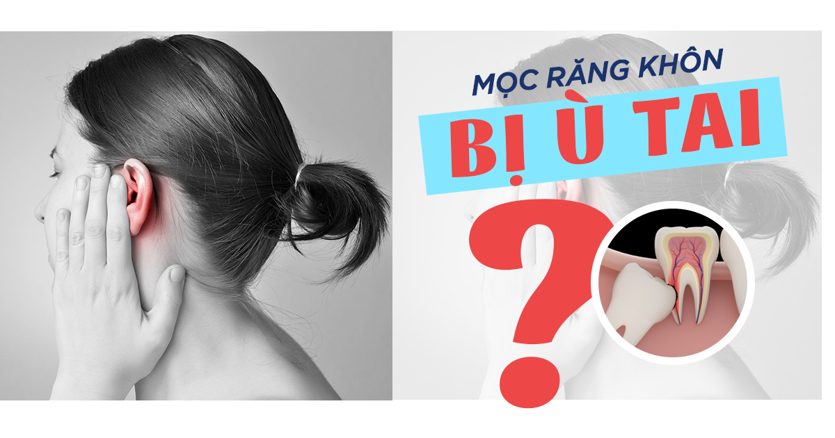 Mọc Răng Khôn Ù Tai: Nguyên Nhân Và Cách Xử Lý 7