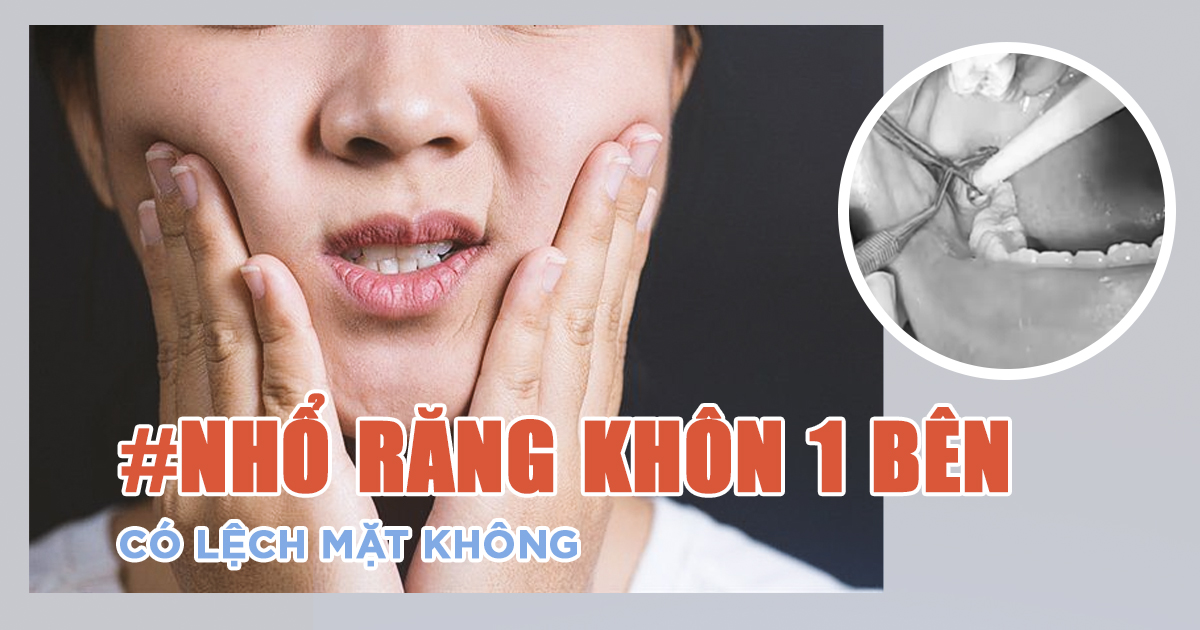 Nhổ Răng Khôn 1 Bên Có Bị Lệch Mặt Không? Sự Thật & Lưu Ý 4