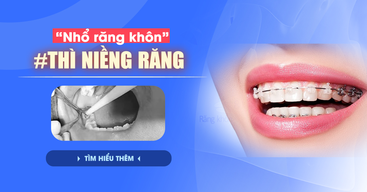 Nhổ Răng Khôn Bao Lâu Thì Niềng Răng Được? Giải Đáp Nhanh