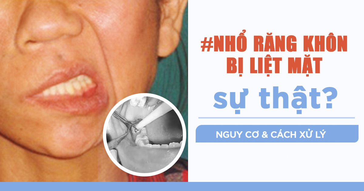 Nhổ Răng Khôn Bị Liệt Mặt: Sự thật, Nguy Cơ và Cách Xử Lý 3