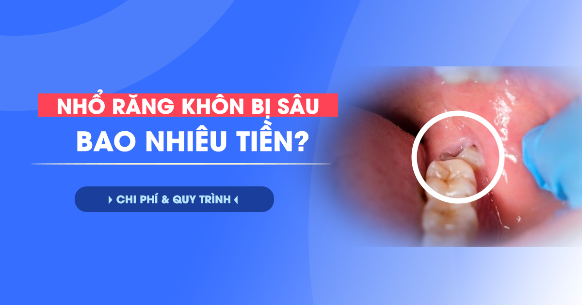 Nhổ Răng Khôn Bị Sâu Bao Nhiêu Tiền? Chi Phí & Quy Trình 3