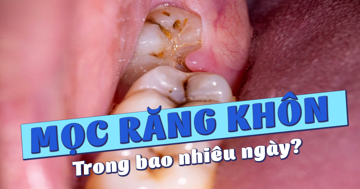 Răng Khôn Mọc Trong Bao Nhiêu Ngày? 5 Yếu Tố Ảnh Hưởng 8