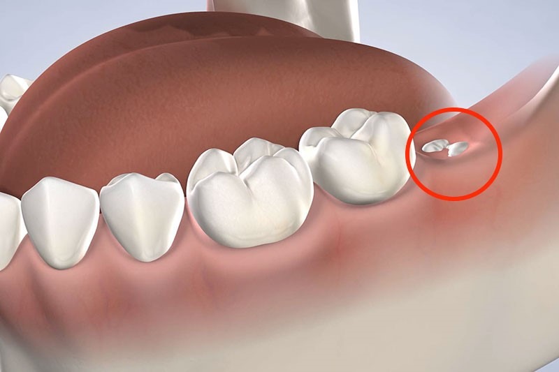 Mọc Răng Khôn Ù Tai: Nguyên Nhân Và Cách Xử Lý 3