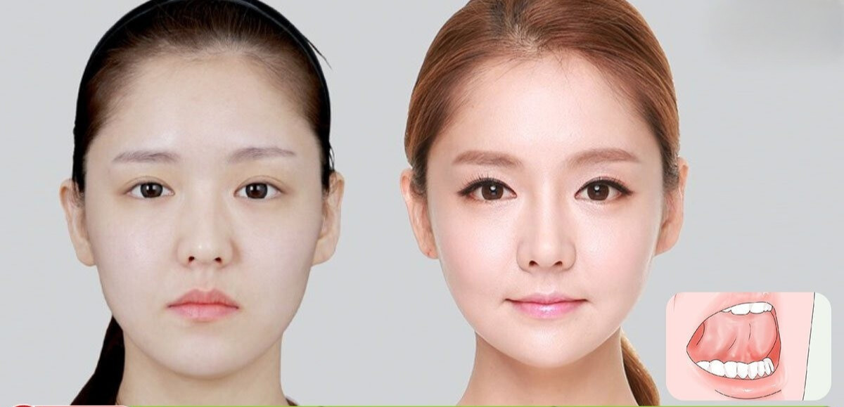 Nhổ Răng Khôn 1 Bên Có Bị Lệch Mặt Không? Sự Thật & Lưu Ý 2