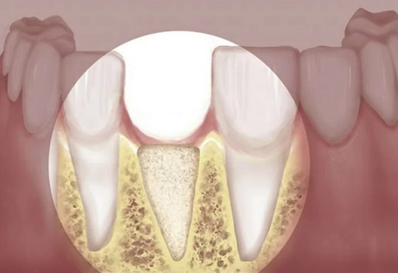 Nhổ Răng Khôn 1 Bên Có Bị Lệch Mặt Không? Sự Thật & Lưu Ý 5