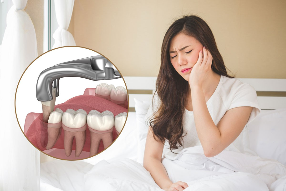 Sự thật về nhổ răng khôn bị liệt mặt