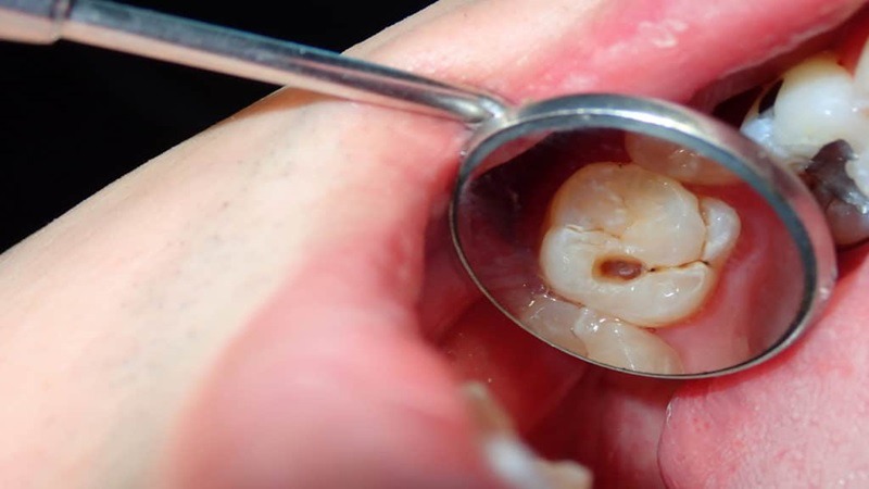 Nhổ Răng Khôn Bị Sâu Bao Nhiêu Tiền? Chi Phí & Quy Trình 2