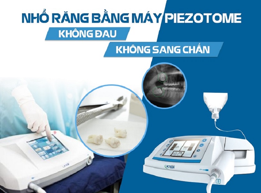 Nhổ Răng Khôn Piezotome Giá Bao Nhiêu? Bảng Giá & Ưu Điểm 5