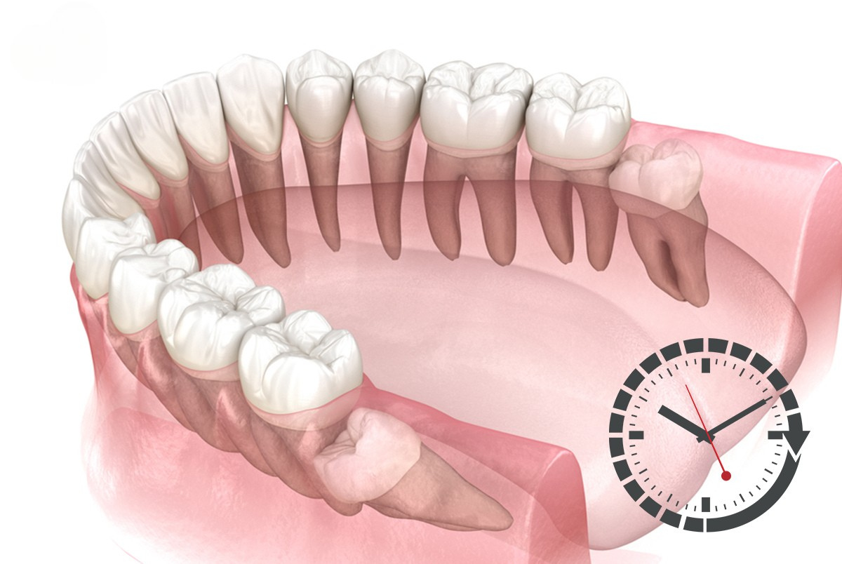 Răng Khôn Mọc Trong Bao Nhiêu Ngày? 5 Yếu Tố Ảnh Hưởng 2