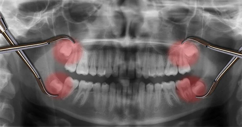 Nhổ 4 răng khôn có ảnh hưởng gì không?