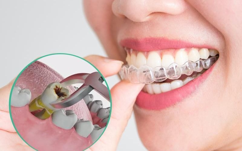 Vì sao phải nhổ răng khôn trước khi niềng răng?