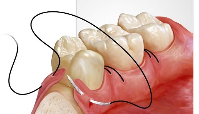 Nhổ răng khôn mấy ngày cắt chỉ