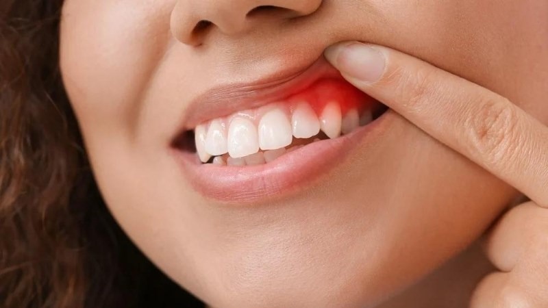 Áp xe răng có triệu chứng gì?