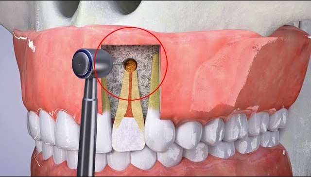 So sánh chi phí điều trị nội nha và phẫu thuật cắt chóp