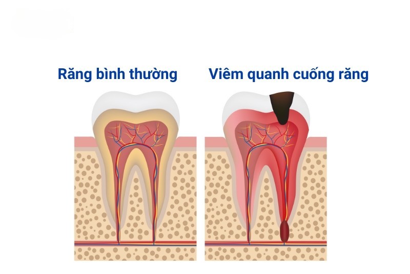 Viêm quanh chóp mạn tính là gì?