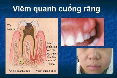 Viêm quanh cuống răng là gì? Có khác gì không?