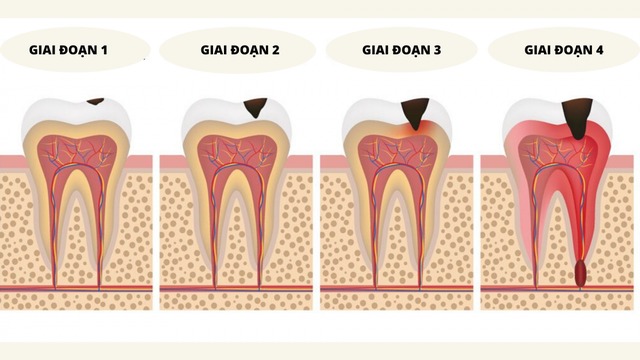 Viêm quanh chóp cấp và mạn tính khác nhau thế nào?