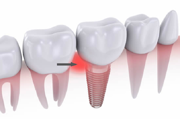 Dấu hiệu nhận biết viêm quanh implant