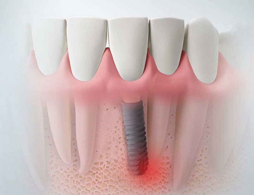 Phác Đồ Điều Trị Viêm Quanh Implant Theo Mức Độ Bệnh