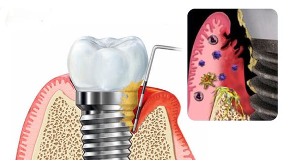 Khi Nào Cần Điều Trị Viêm Quanh Implant