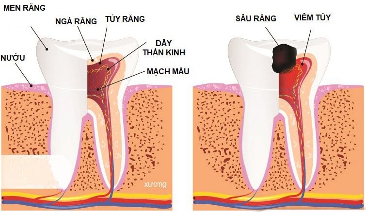 Nguyên nhân và cơ chế hình thành viêm quanh chóp